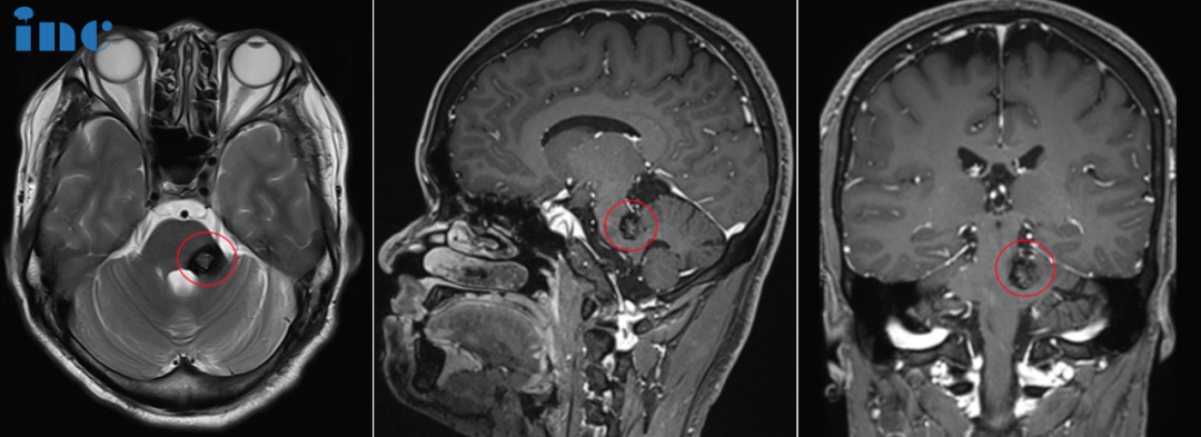 脑干海绵状血管瘤术前MRI