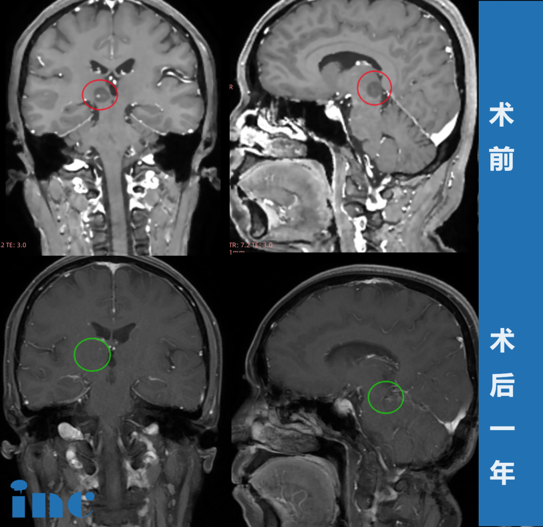 高难度丘脑胶质瘤术后患者自述——影像