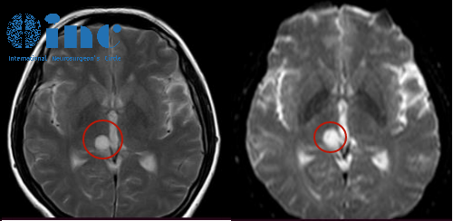 高难度丘脑胶质瘤术后患者自述——影像图