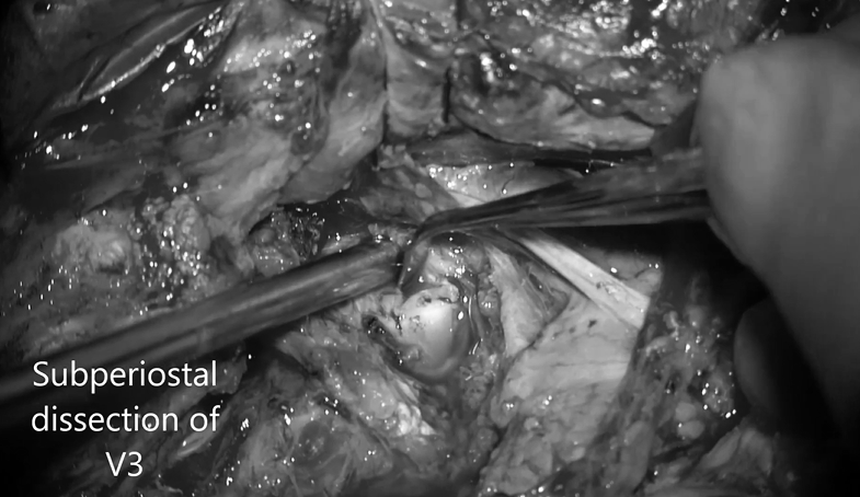 颅外椎动脉V3段骨膜下剥离术解剖动脉，保留静脉丛