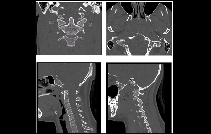 双镜联合全切颅颈交界区脊索瘤——CT