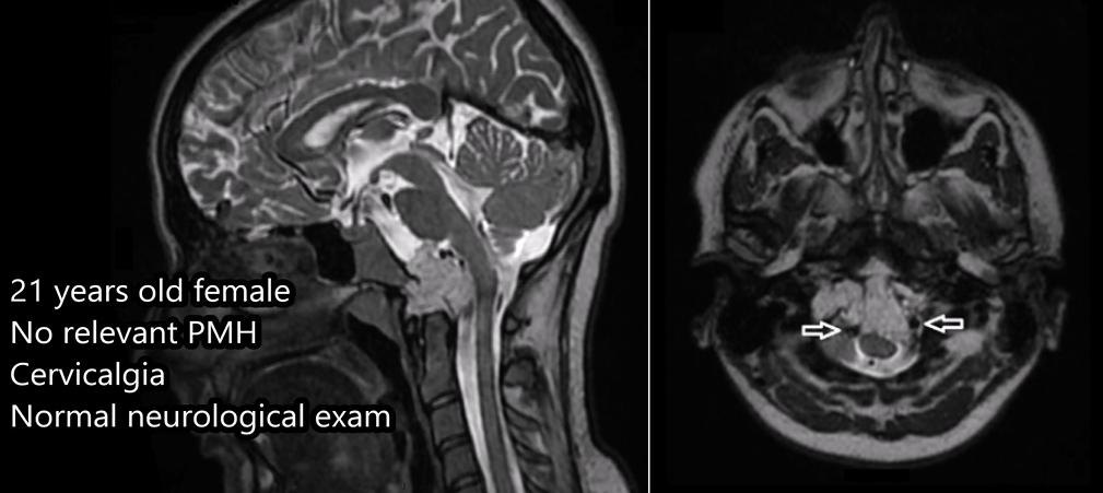 双镜联合全切颅颈交界区脊索瘤——术前MRI