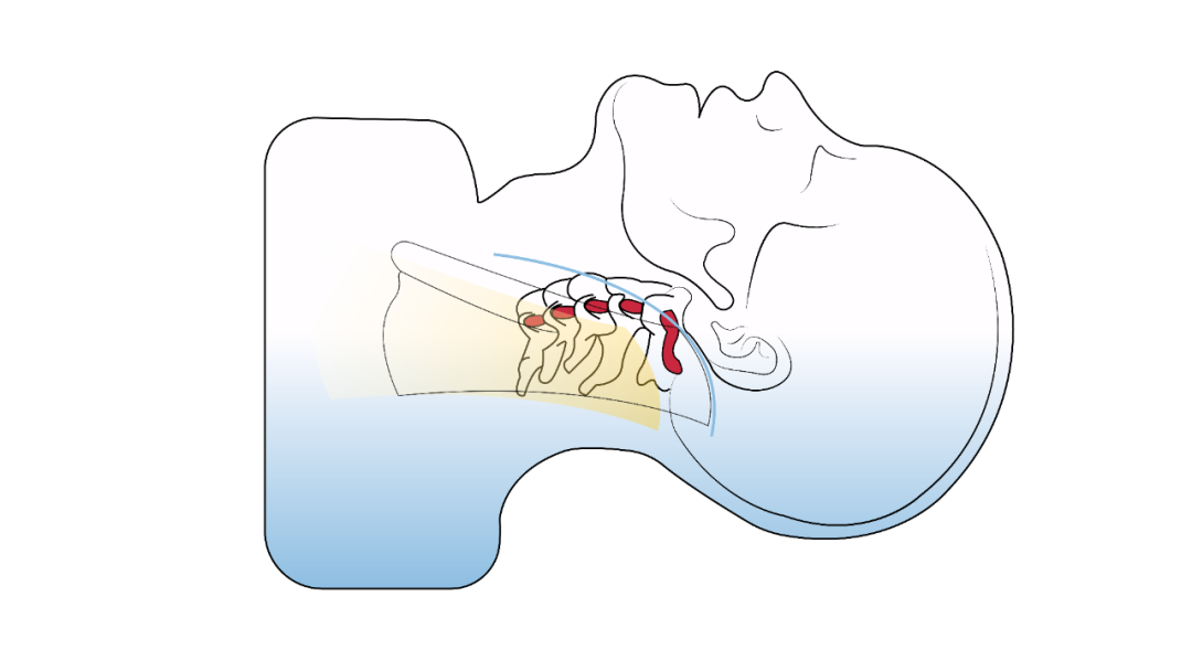 由胸锁乳突肌和颈静脉之间的走廊组成的前外侧入路来接近肿瘤。