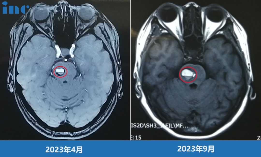 脑干海绵状血管瘤影像