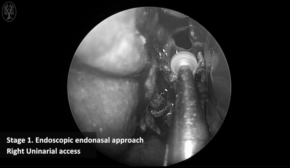内镜经鼻入路——右侧单鼻孔入路