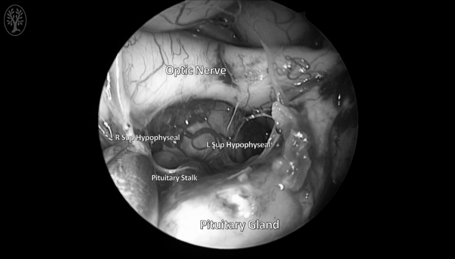 视神经、垂体、垂体柄等得到暴露