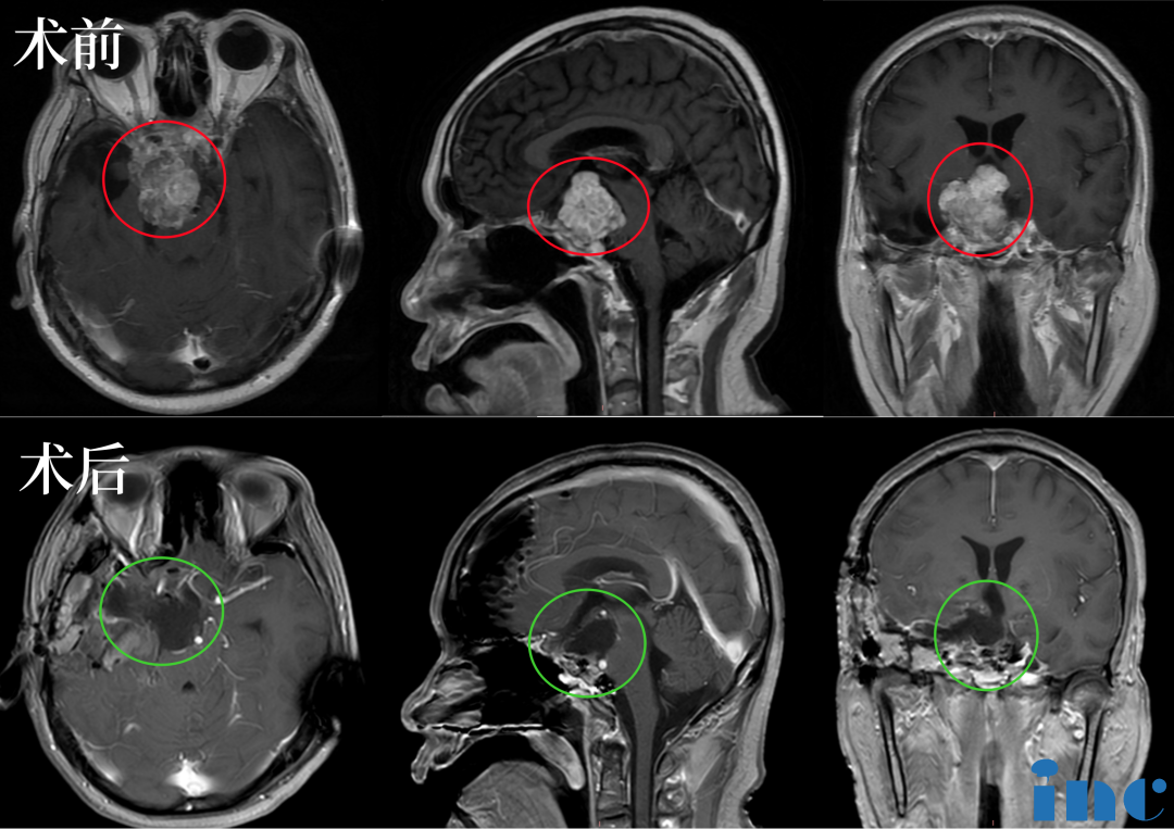 术后：手术顺利，术中将鞍上鞍内、海绵窦区、三脑室肿瘤切除