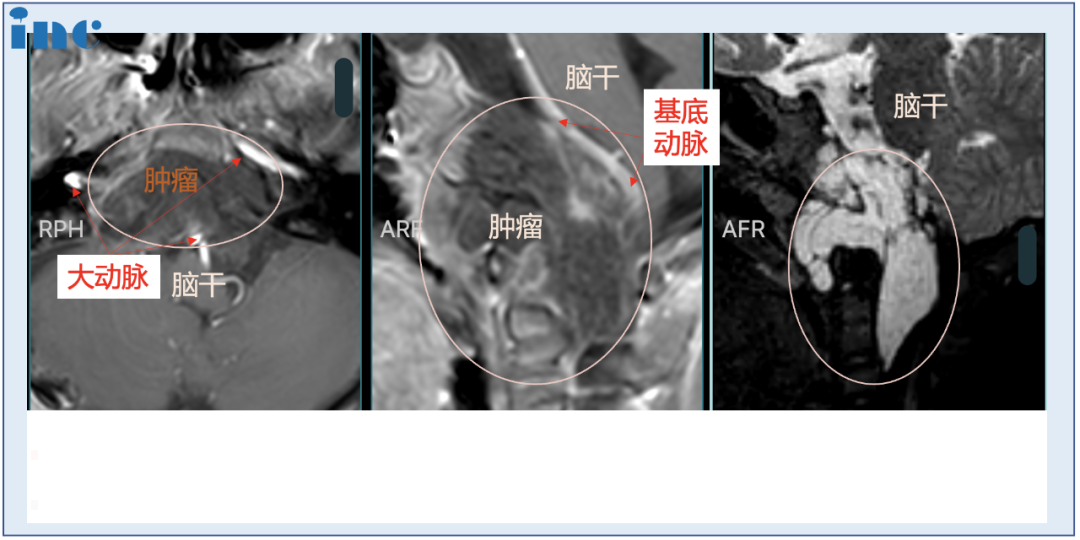 术后：手术顺利，术中将鞍上鞍内、海绵窦区、三脑室肿瘤切除