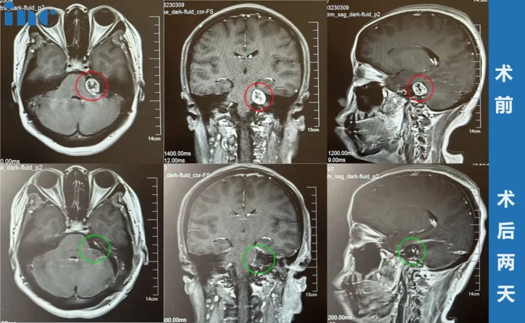 吴女士术前术后MRI对比显示肿瘤得到全切
