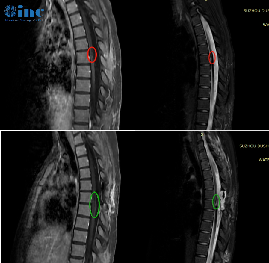 脊髓肿瘤手术——影像对比