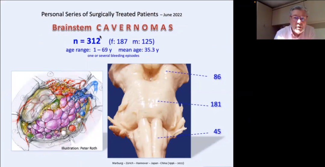INC巴教授近300多例脑干海绵状血管瘤案例解析