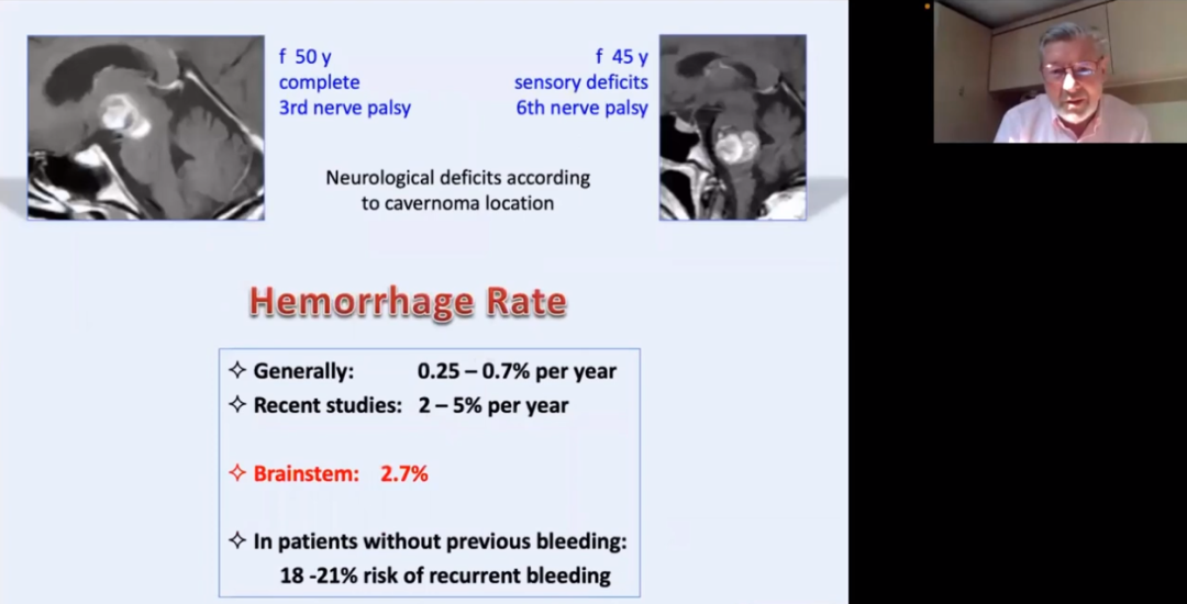 INC巴教授近300多例脑干海绵状血管瘤案例解析