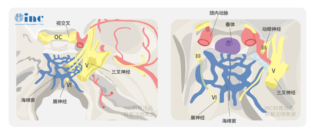 【国际脊索瘤手术大咖案例】联合岩骨入路切除岩斜区肿瘤手术图解