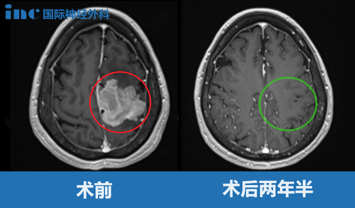 大脑镰旁较大脑膜瘤——影像