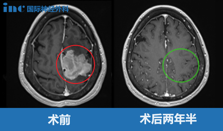 大脑镰旁巨大脑膜瘤——影像