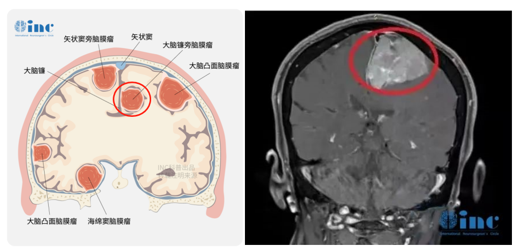 大脑镰旁巨大脑膜瘤