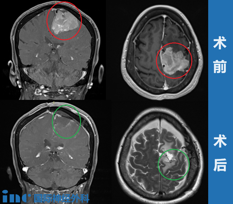 大脑镰旁巨大脑膜瘤——术前术后