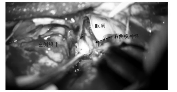 充分游离、松解右侧嗅神经