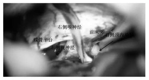 充分游离后可见视神经、嗅神经、颈内动脉、前床突等结构