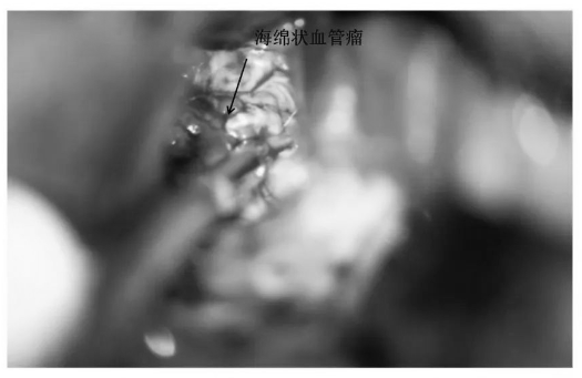 继续沿周边黄染的含铁血黄素沉积带分离肿瘤（好的操作+细致的双较）