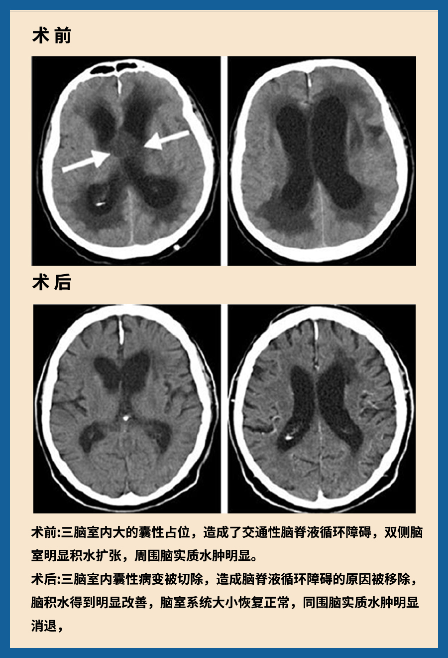 颅咽管瘤治疗案例