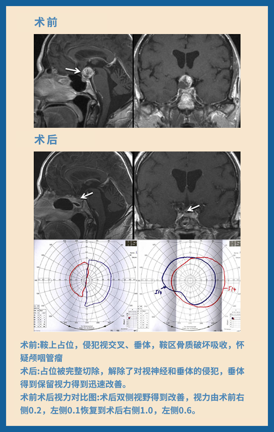 颅咽管瘤治疗案例