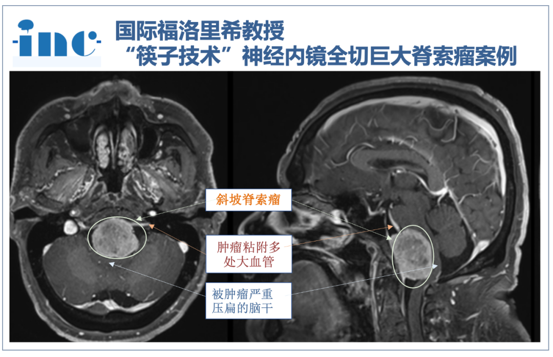 「成果发表」INC国际教授独创“筷子技术”，单鼻孔内镜下全切斜坡脊索瘤