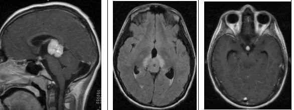 松果体区肿瘤——影像