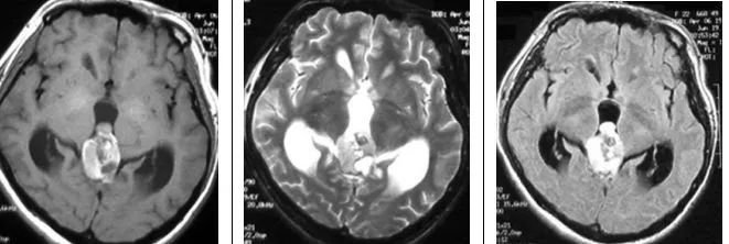 中分化松果体实质肿瘤（WHOⅡ级或Ⅲ级）