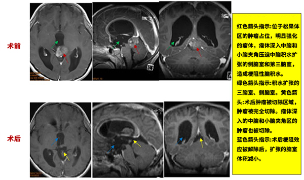 CASE 5：8岁男孩-松果体肿瘤