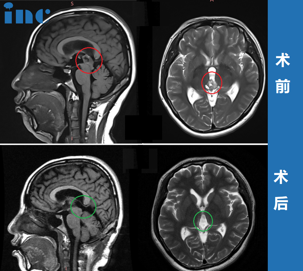 CASE 1：36岁女性-松果体区占位手术