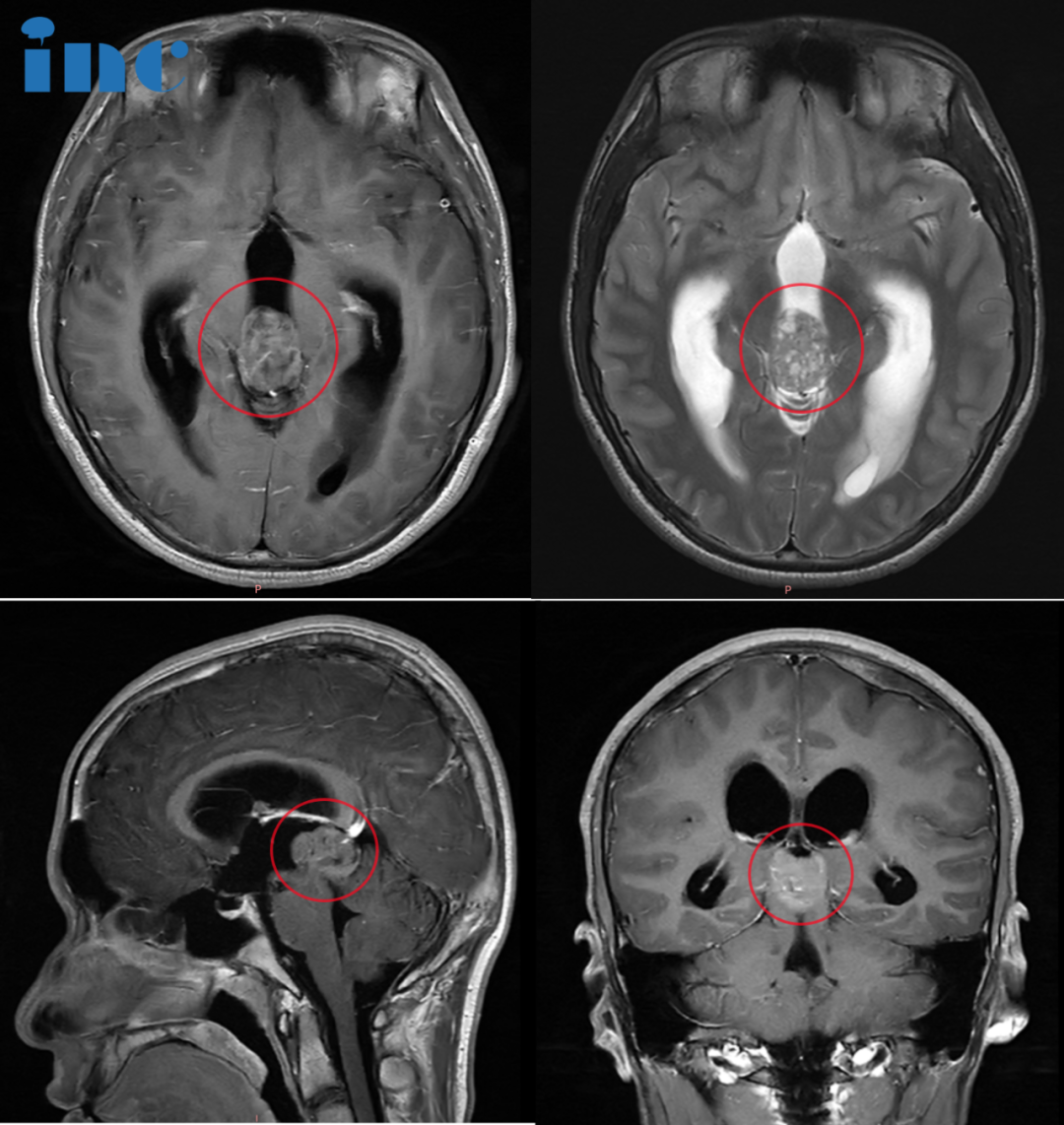 CASE 1：36岁女性-松果体区占位手术