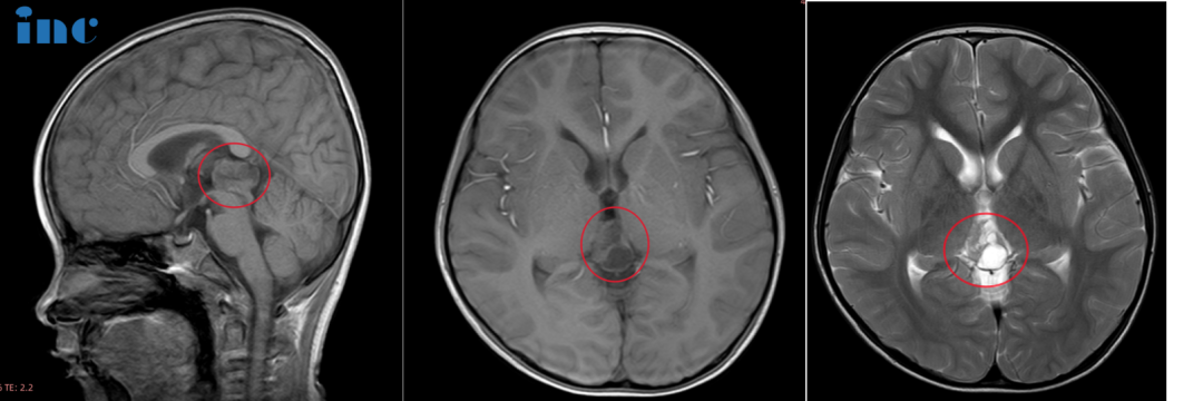 CASE 3：6岁男孩-松果体占位性病变