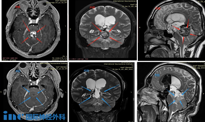 CASE 4：40岁女士-松果体肿瘤