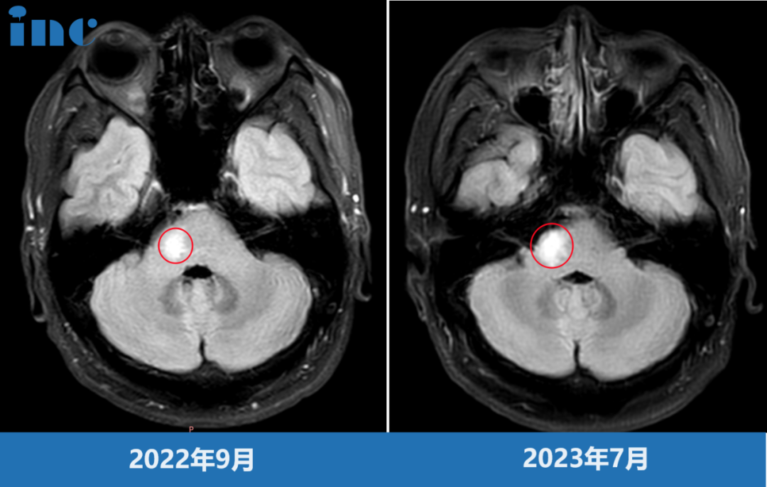 低级别胶质瘤早期手术