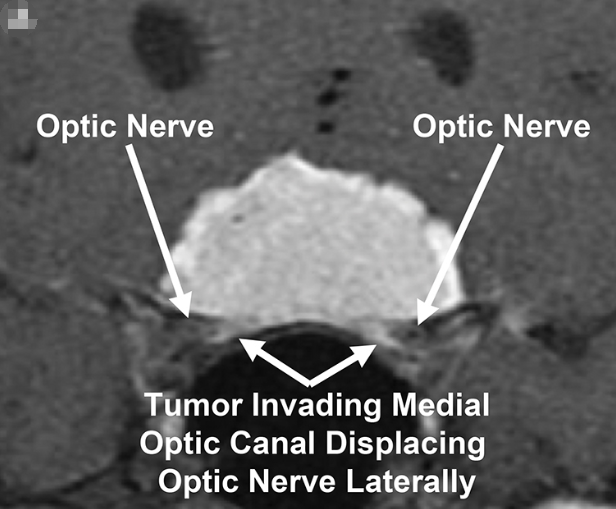 冠状位增强后T1加权MR图像显示双侧视神经管被鞍结节脑膜瘤侵犯