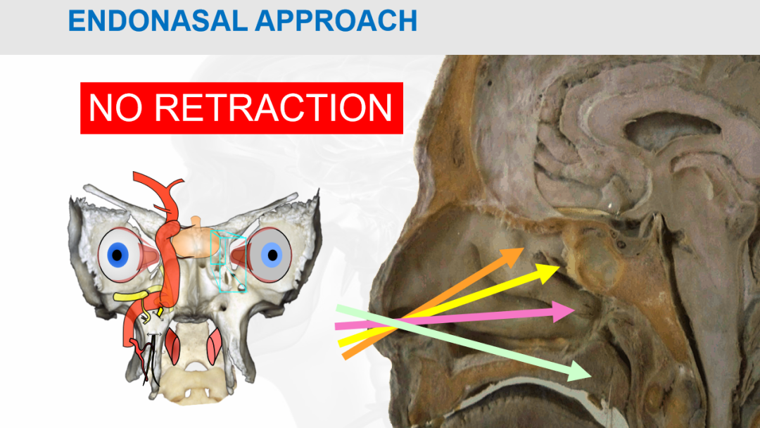 经鼻内镜手术入路示意图