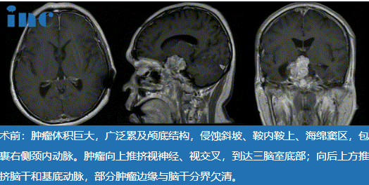 48岁较大脊索瘤复发患者，“双镜联合”中国示范手术