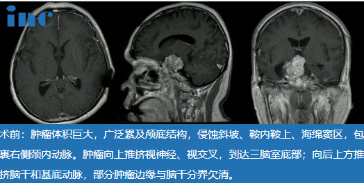 48岁巨大脊索瘤复发患者，“双镜联合”中国示范手术