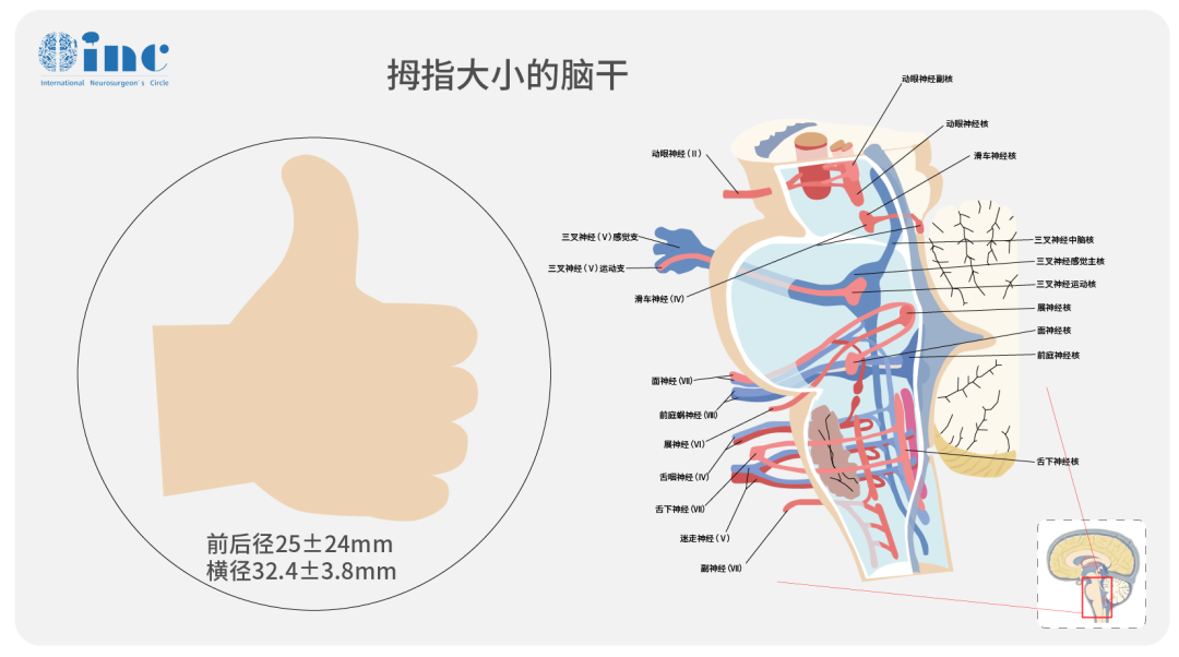 脑干海绵状血管瘤手术