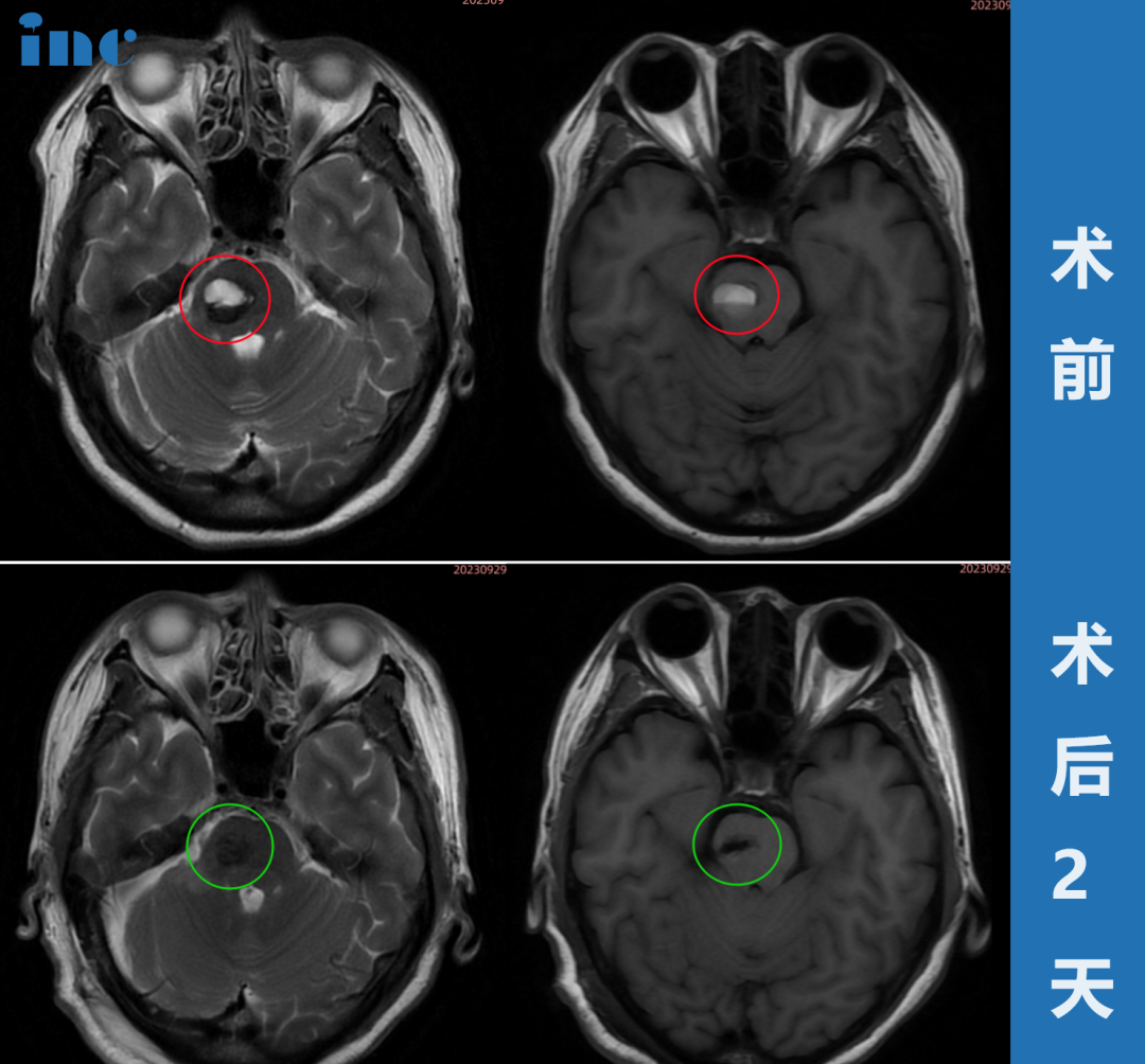 52岁女性•脑干-脑桥海绵状血管瘤