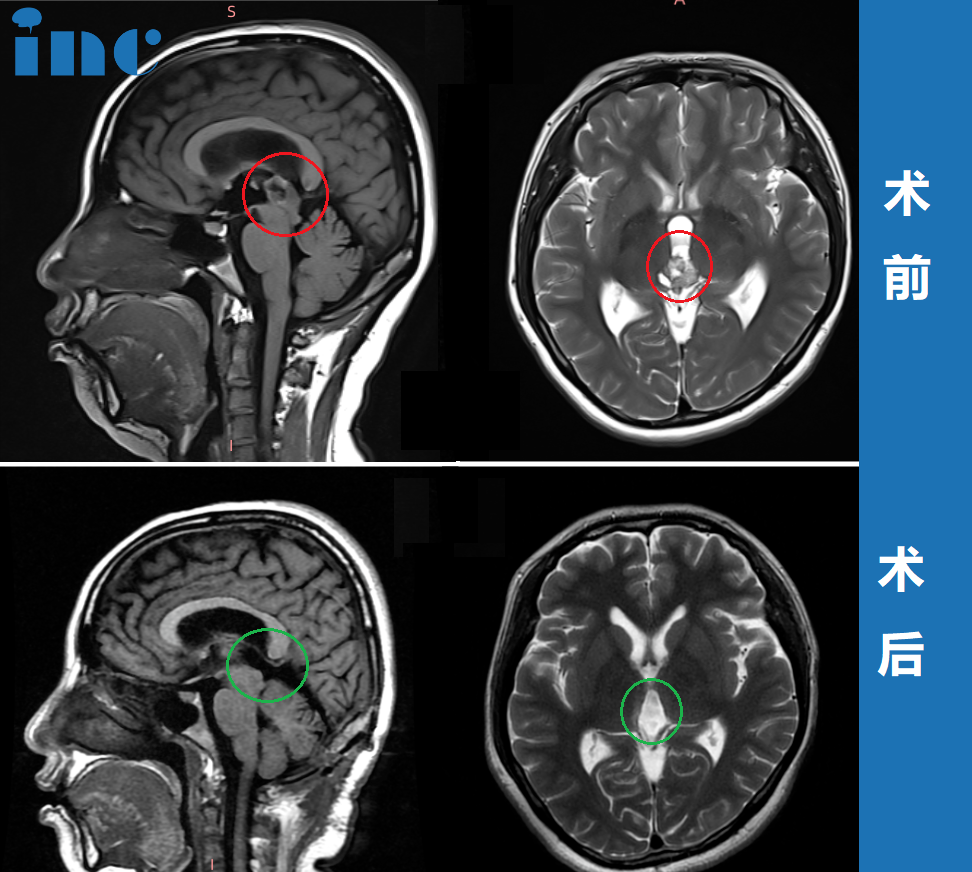 36岁女性-松果体区肿瘤