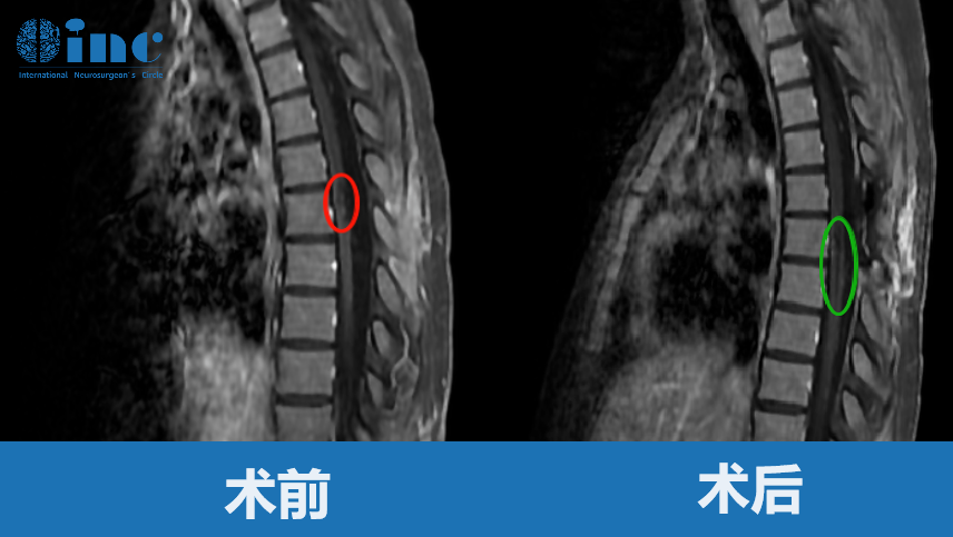 20岁女性-胸髓髓内海绵状血管瘤