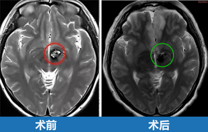 30岁女性-丘脑海绵状血管瘤