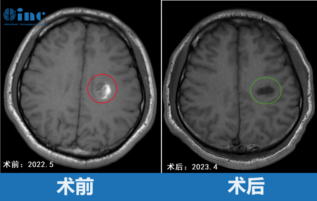 23岁男性-半卵圆中心海绵状血管瘤