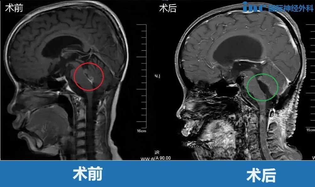 11岁男孩-四脑室肿瘤