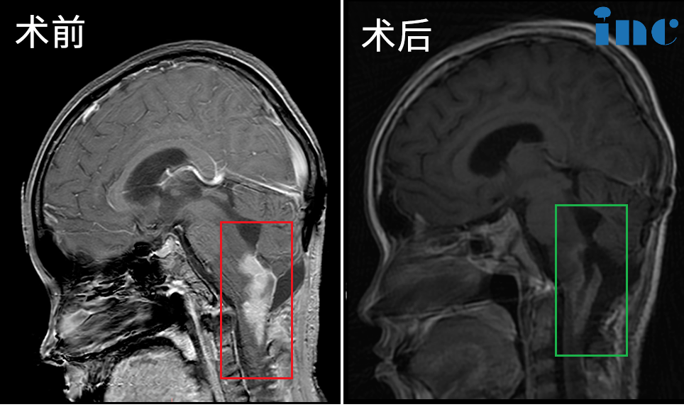 13岁男孩-脑干脊髓胶质瘤