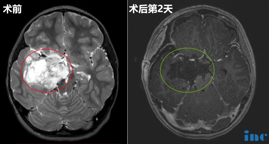 6岁女孩-颞叶岛叶胶质瘤