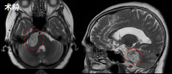 听神经瘤案例——术前影像