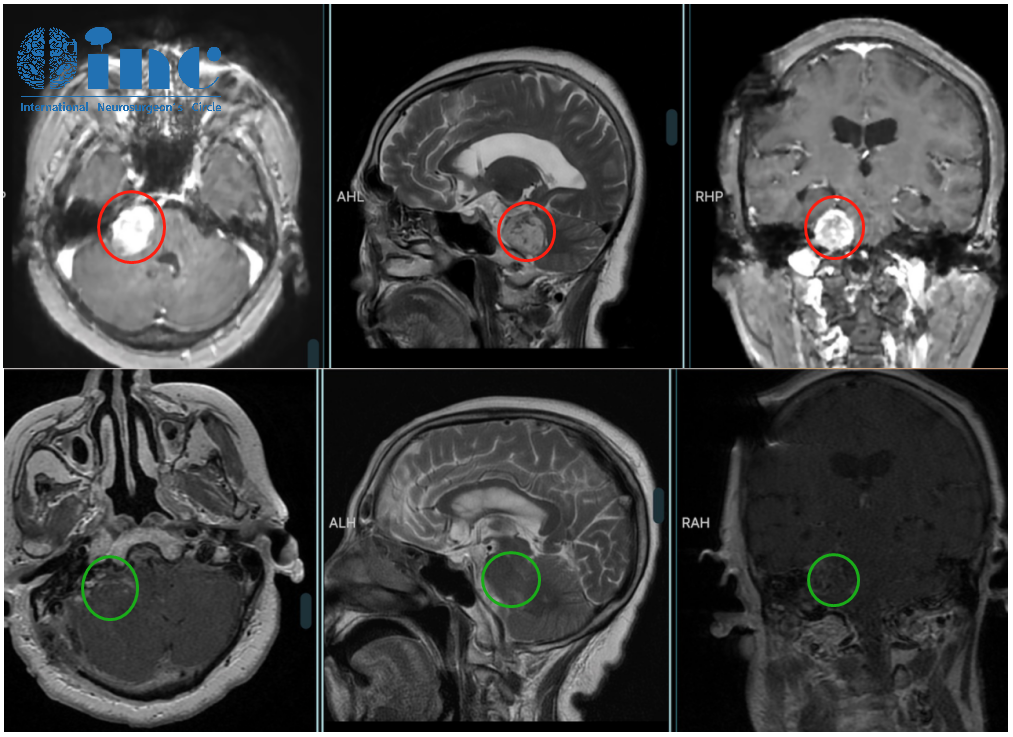 听神经瘤案例——术前术后影像